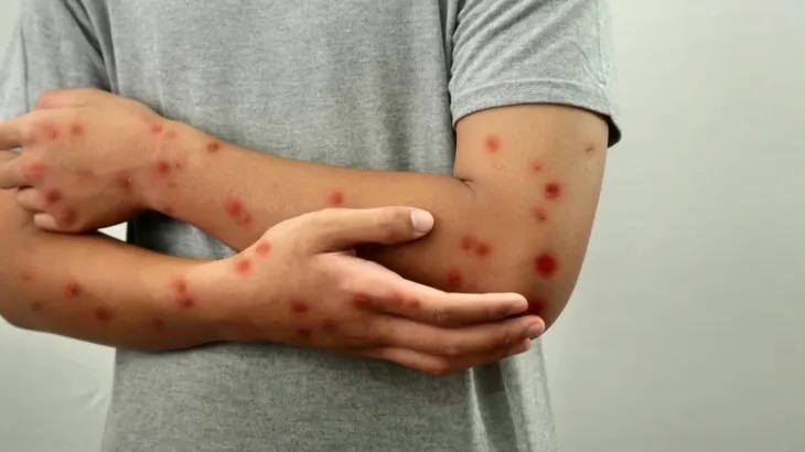 الوضع يتأزم في إفريقيا والصحة العالمية تؤكد:  جدري القردة ليس "كوفيدا جديدا"